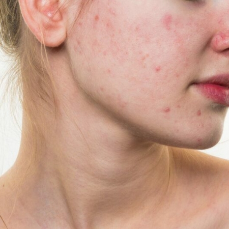 Đang Có Mụn Thì Wax Lông Được Không?