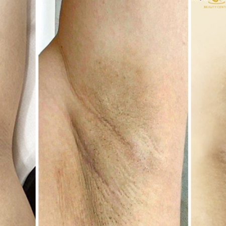 Wax lông nách có bị thâm không? Nguyên nhân và cách xử lí